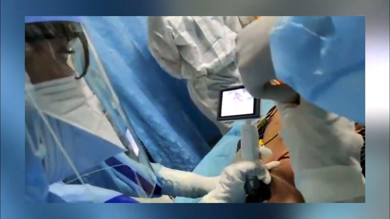 What Inside of Trachea ? Video Laryngoscopy CMac intubation