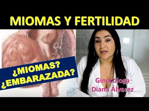 Vídeo: Comparación Del Patrón De Crecimiento De Los Fibromas Uterinos Durante El Embarazo Según El Sexo Fetal: Un Estudio Observacional