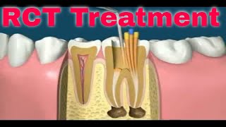 Root Canal Rct Treatment Step By Step In Details Endodontics Procedure Animation Mydentcart