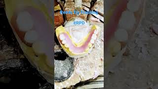 Removable Partial Denture Ready For Flasking... ..