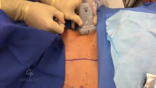 Ultrasound Pectoralis (PECS) Block 1 and 2 for Breast Surgery