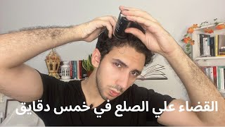 القضاء علي الصلع في خمس دقايق