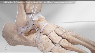 DX FiberTak® Soft Anchor for Brostrom Repair With InternalBrace™ Ligament Augmentation screenshot 4