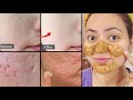 7 Days Challenge Get Rid Of OPEN PORES LARGE PORES CLOGGED PORES Permanently In 7 Days 
