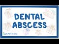 Dental abscess - causes, symptoms, diagnosis, treatment, pathology