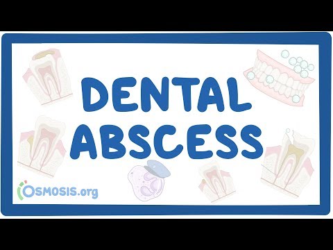 Dental abscess - causes, symptoms, diagnosis, treatment, pathology