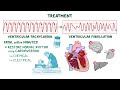 Ventricular tachycardia