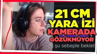 Doğukan Adal 128 Dikişlik Yara İzlerini Gösteriyor