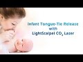 Infant Laser Frenectomy Tongue Tie Release LightScalpel Laser