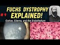 Fuchs Dystrophy Simplified From Guttae To Grafts Fuchs Dystrophy Simplified From Guttae To Grafts