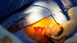 Full details caesarean section