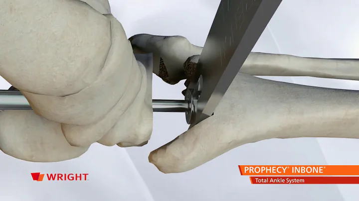 INBONE™ with PROPHECY™ Surgical Technique Animation