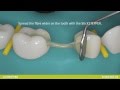 everStickC&B fibre reinforced bridge for posterior region.wmv