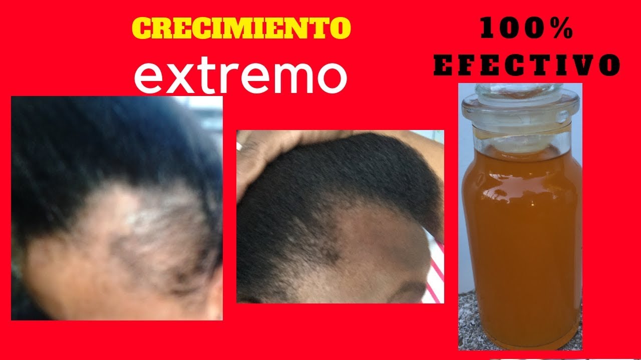 El Mejor Tratamiento Caida de Pelo y Crecimiento ,AFRO