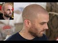 Scalp pigmentation results from skalptec  amazing outcome for music producer 