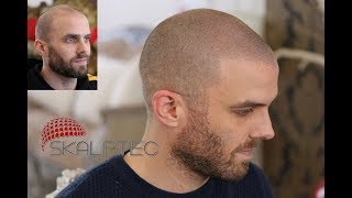 Scalp Pigmentation Results from Skalptec | Amazing Outcome for Music Producer |