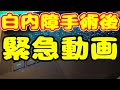 白内障手術後に撮った白内障手術の日の記録