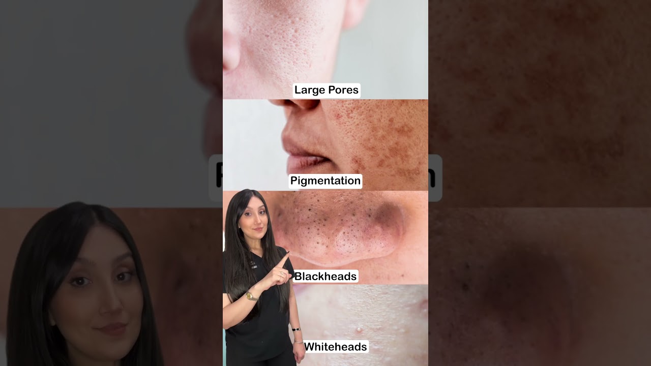 Tips for scars, stretch marks, hyperpigmentation, blackheads and acne! 