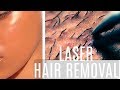 Get Rid of FACIAL HAIR| Laser Hair Removal| FULL Process + RESULTS!