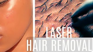 Get Rid of FACIAL HAIR| Laser Hair Removal| FULL Process + RESULTS!