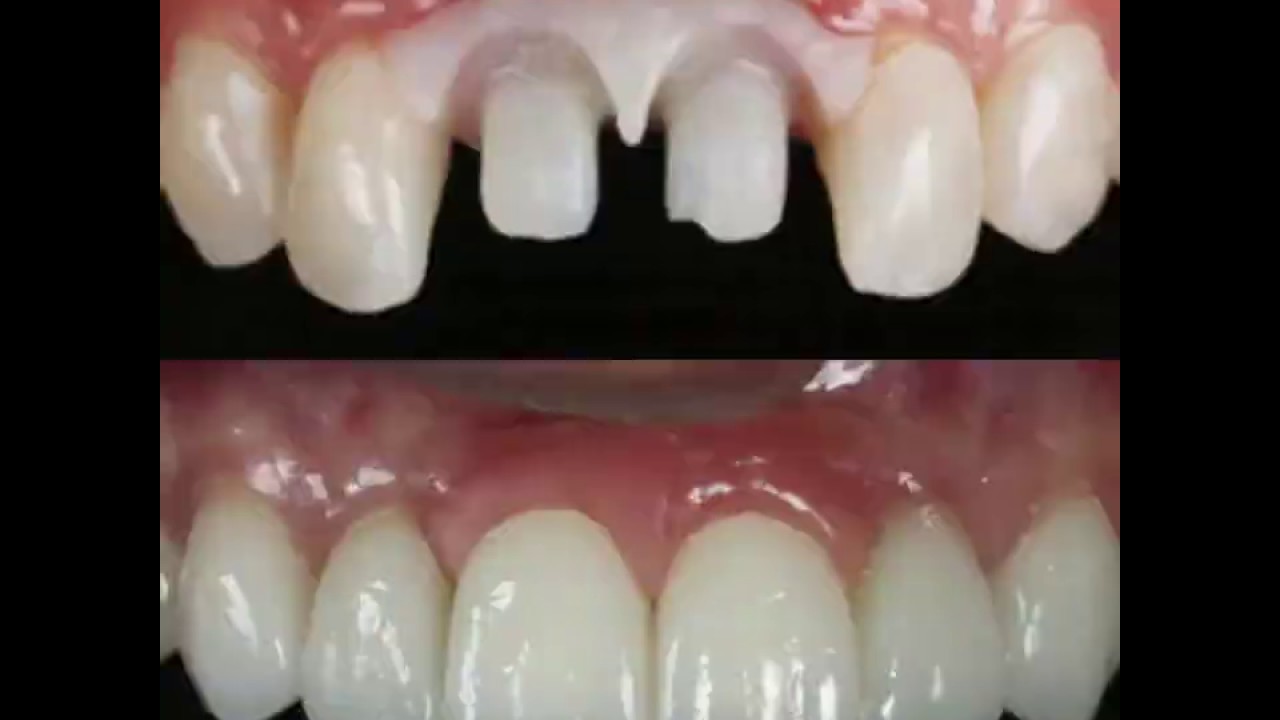 Grande transformação dentes de porcelana e implantes dentários YouTube