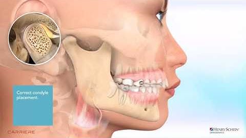 Carriere® Motion™ Appliance for Class II Patient Education Animation