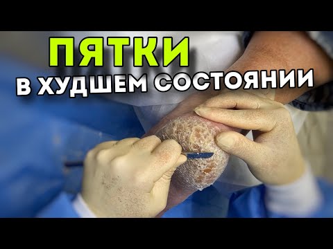 Окаменевшая кожа на пятках | результат до и после | #подологтатьянапак