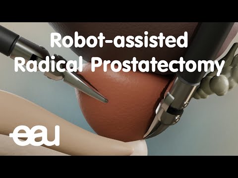 Video: Er prostatektomi en større operation?