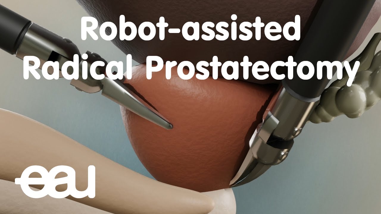 Youtube Video: Robot-assisted Radical Prostatectomy (RARP)