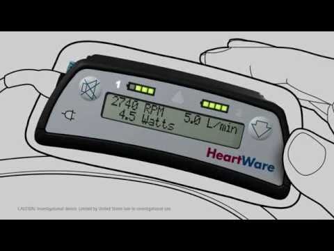 lvad uk 2011 (HeartWare) - YouTube