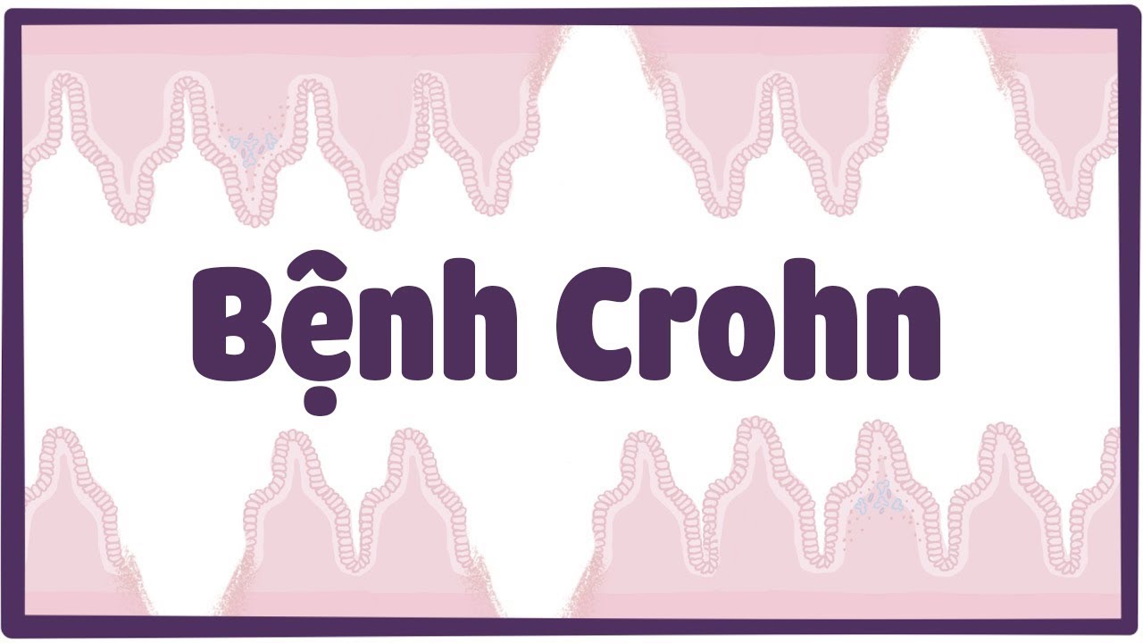 Bệnh Crohn (viêm đường tiêu hóa)