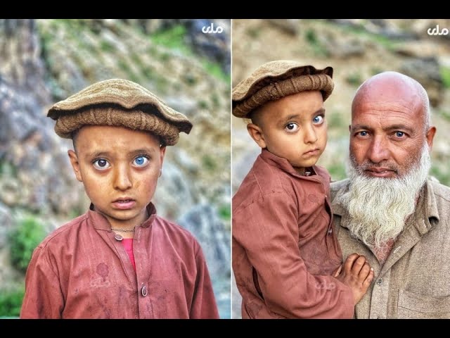 Cиндром Ваарденбурга-Аномалия Тела