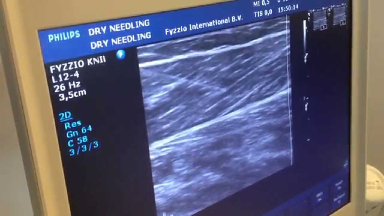 Dry needling under ultrasound YouTube