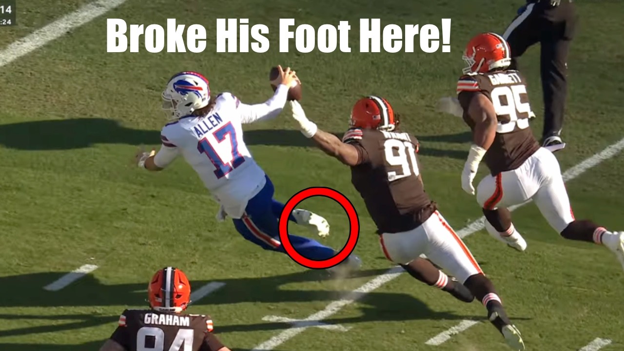 Josh Allen Fractured His Foot and Kept Playing - Doctor Explains Surgery Update