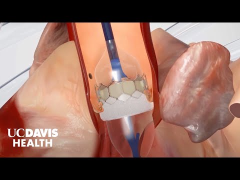 Transcatheter Aortic Valve Replacement (TAVR) - A Less-Invasive Alternative to Open Heart Surgery
