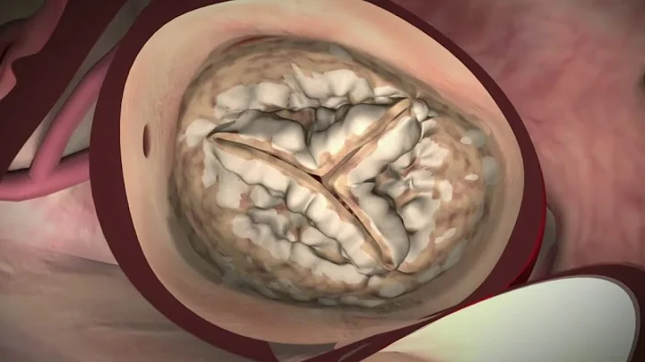 Transcatheter Aortic Valve Replacement (TAVR) - A Less-Invasive Alternative to Open Heart Surgery - DayDayNews