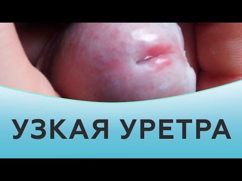 Видео: Что такое наружное отверстие уретры?