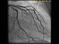 Coronary angiography  nejm