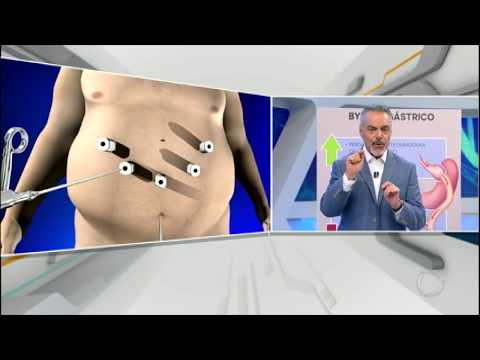 Vídeo: A Cirurgia De Redução Do Estômago é O Método Mais Eficaz Para Perder Peso