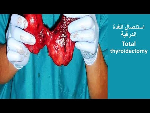 Total Thyroidectomy  استئصال الغدة الدرقية