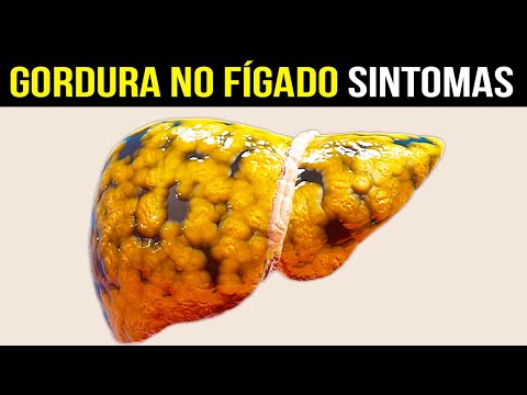 10 Sintomas de Gordura no Fígado [CUIDADO COM ESSES SINAIS]