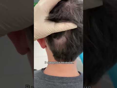Очаговая алопеция