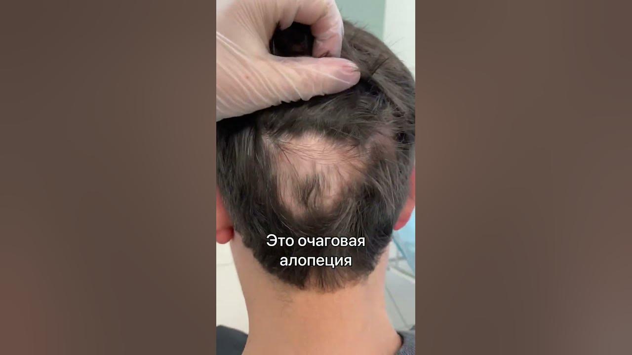 Очаговая алопеция - YouTube