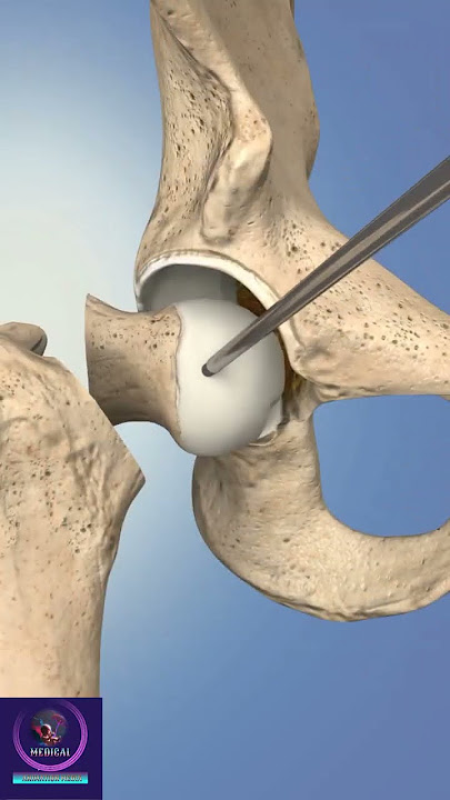 Hip Replacement Anterior Surgery #shorts #education