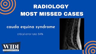 Most Missed Cases: Cauda Equina Syndrome