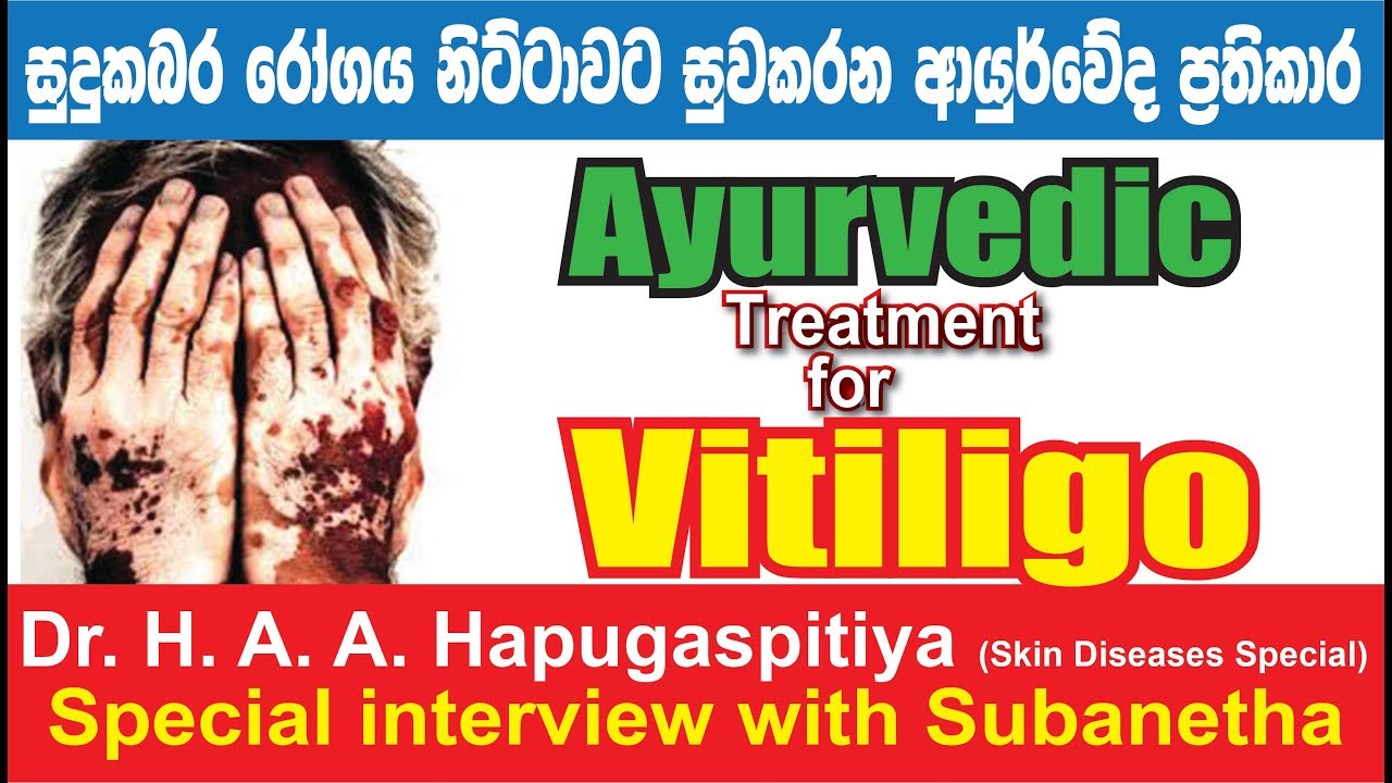 Vitiligo " Sudu kabara " Ayurvedic treatment sri lanka.... Dr H.A.A