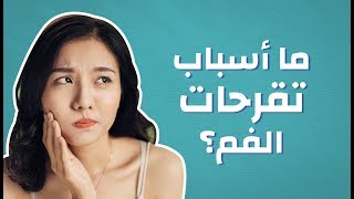 ما أسباب تقرحات الفم #موضوع