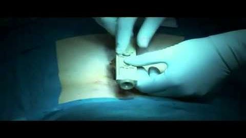 Mazor Robotics Renaissance - How It Works.mp4