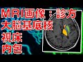 【脳画像：MRI】大脳基底核・視床・内包をMRI画像にて同定する方法を解説します！