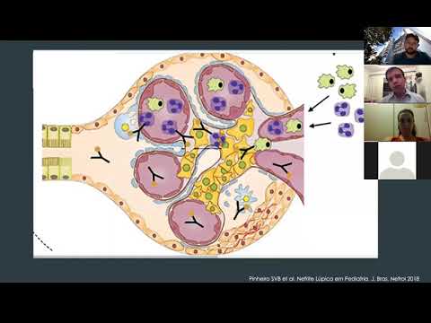 Vídeo: Estudo Piloto Comparando Os Planos De Tratamento De Consenso Da Aliança De Pesquisa Em Artrite E Reumatologia Para Terapia De Indução De Nefrite Lúpica Proliferativa Juvenil